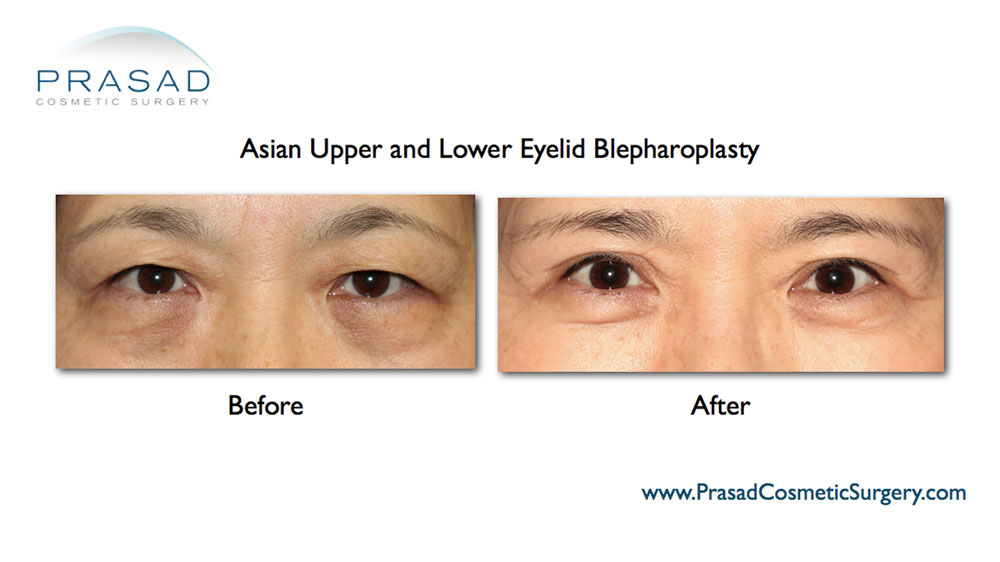 Asian upper and lower blepharoplasty before and after results