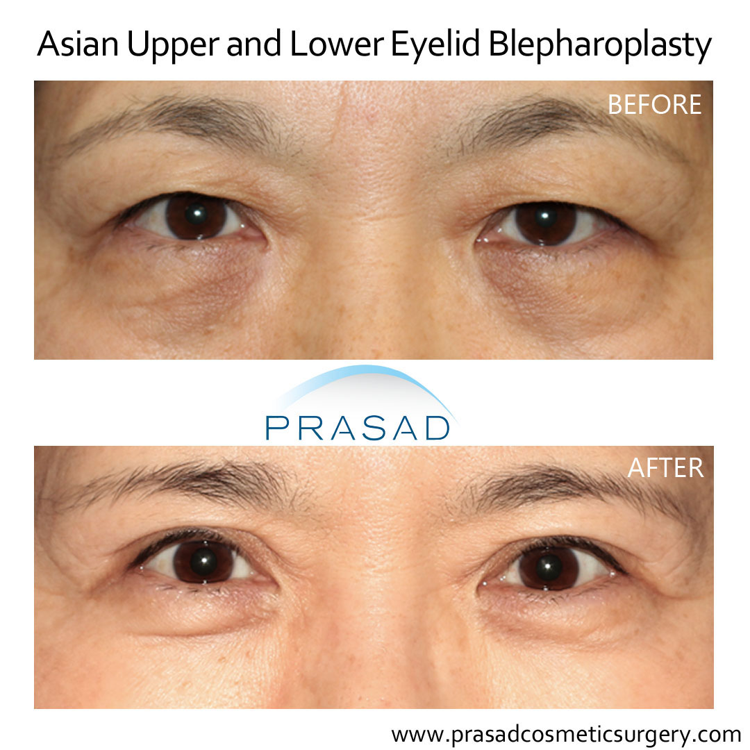 Asian upper and lower blepharoplasty before and after