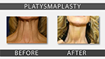 patient photo before and after neck lift
