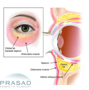 Blepharoplasty Orbital area illustration