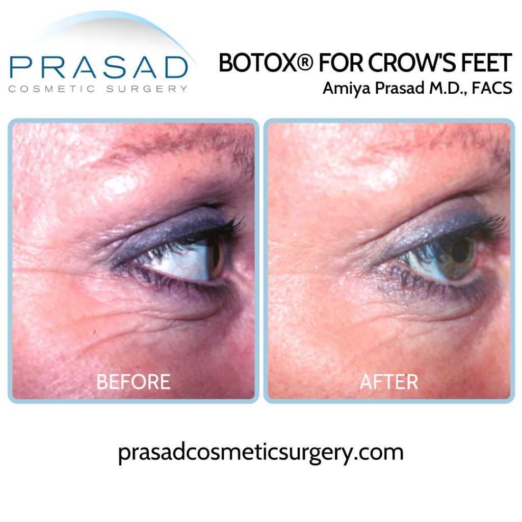before and after Botox injection for Crow's Feet - female patient right eye view