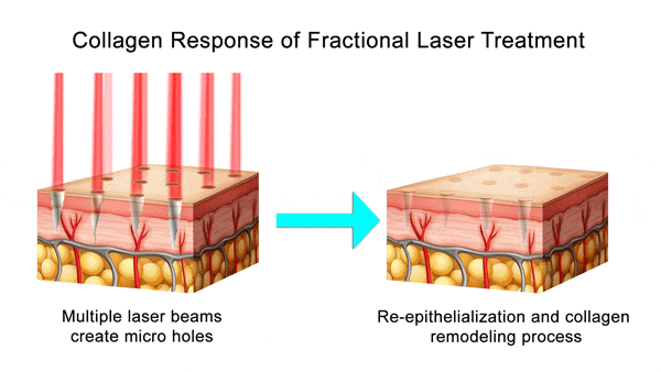 Collagen Response of Fractional Laser Treatment illustration