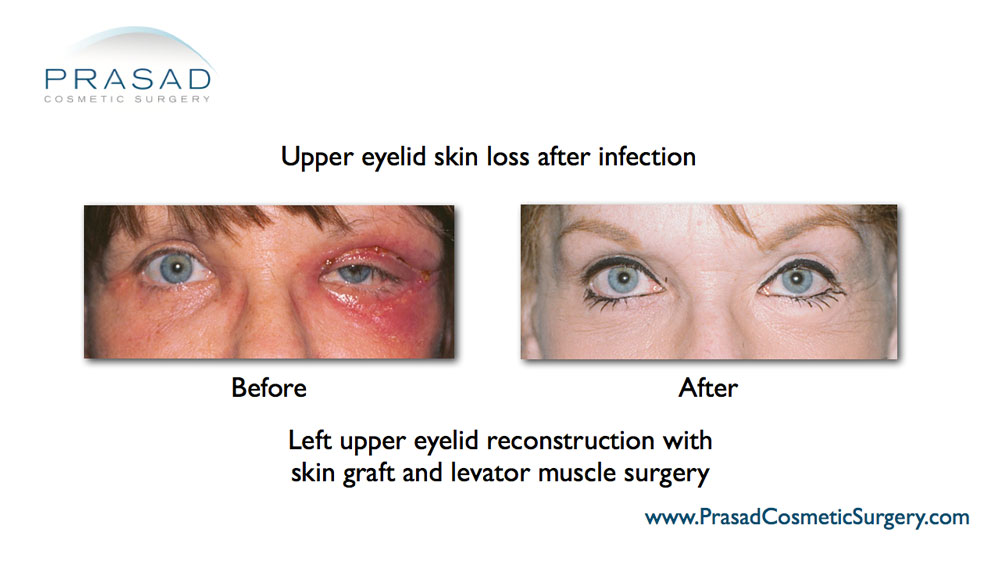 Before and after Eyelid reconstruction surgery female patient