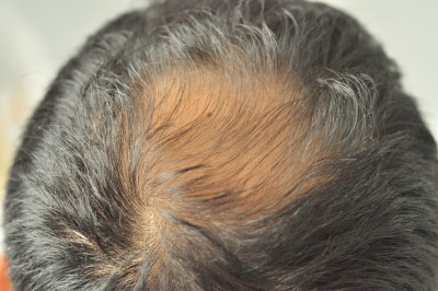 Male head crown with hair loss