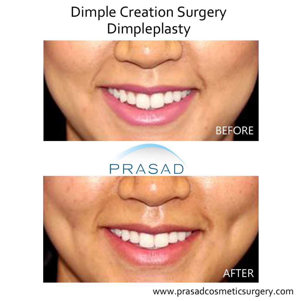 Dimples Surgery Before And After