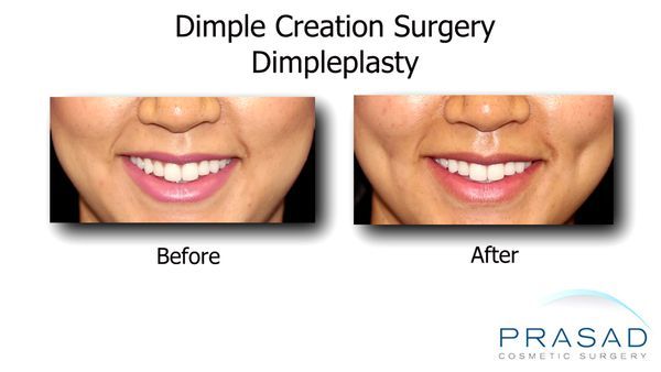 Dimple Surgery Before and After results