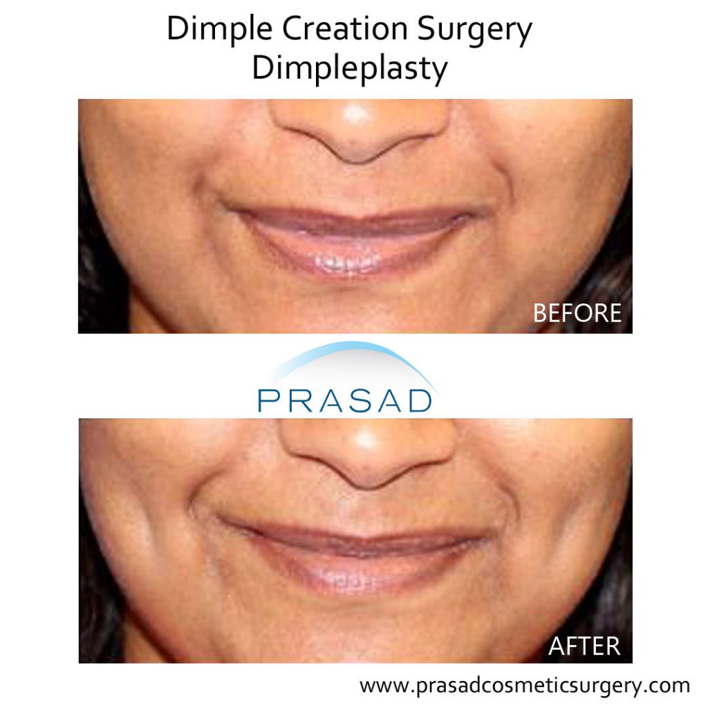 Dimple Creation Surgery Before and After results
