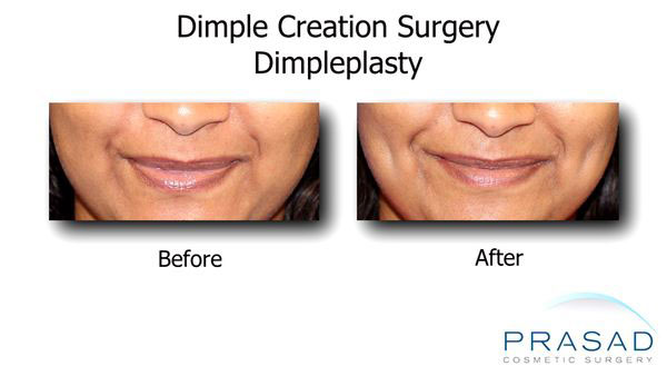 Dimple Creation Surgery Before and After results