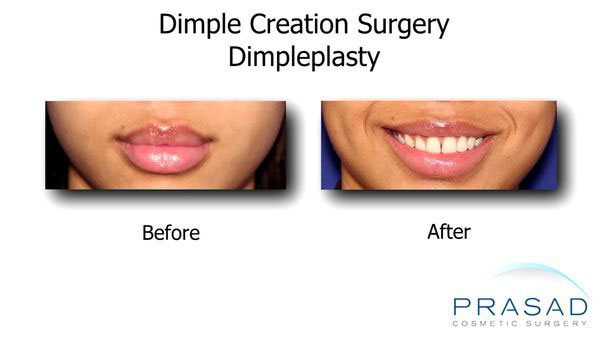 dimpleplasty before and after photo