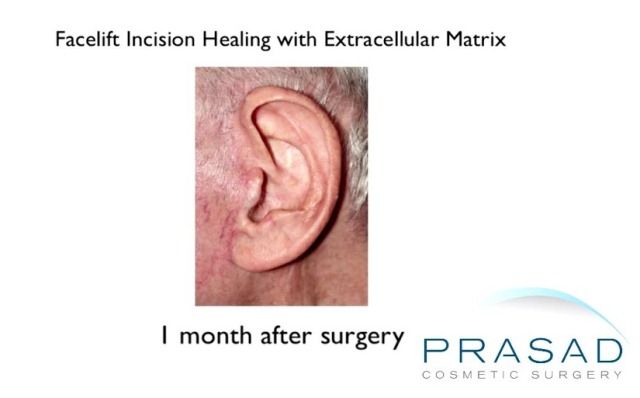 Facelift incision healing with ECM 1 month after surgery