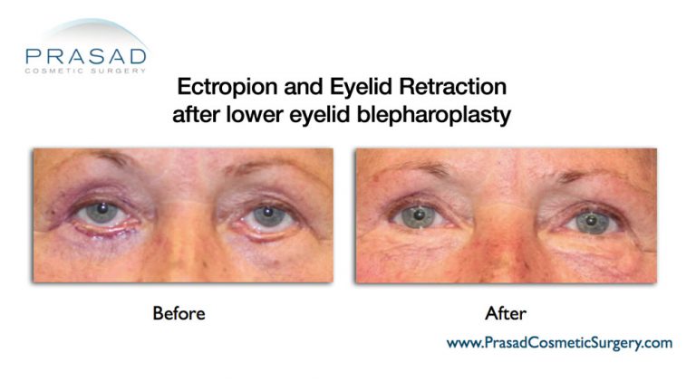 before and after eyelid surgery revision or blepharoplasty revision - older female patient