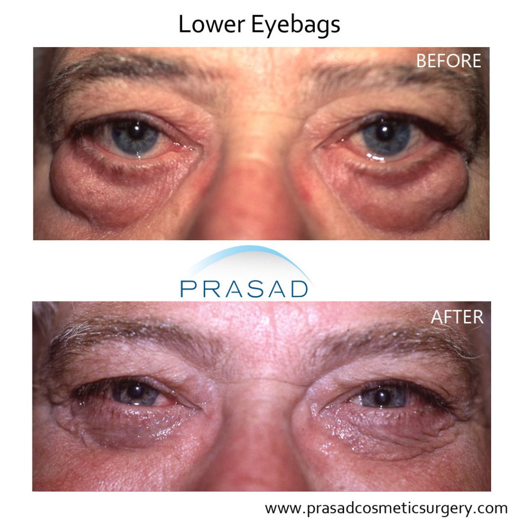 Puffy Eyes and Bags with Eyelid Surgery