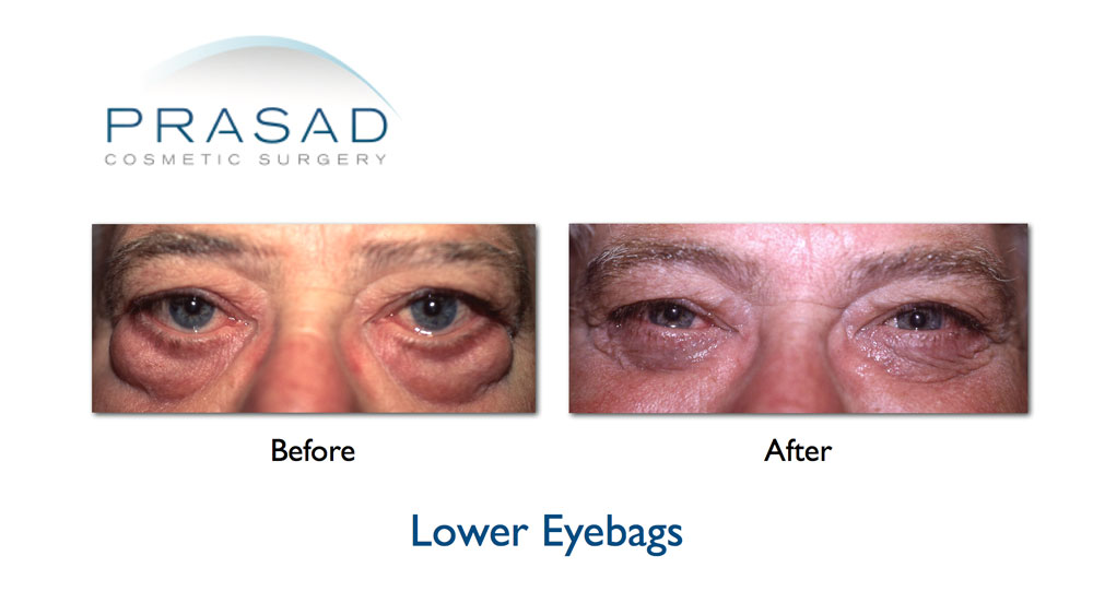 Under Eye Bag Surgery  Prasad Cosmetic Surgery New York