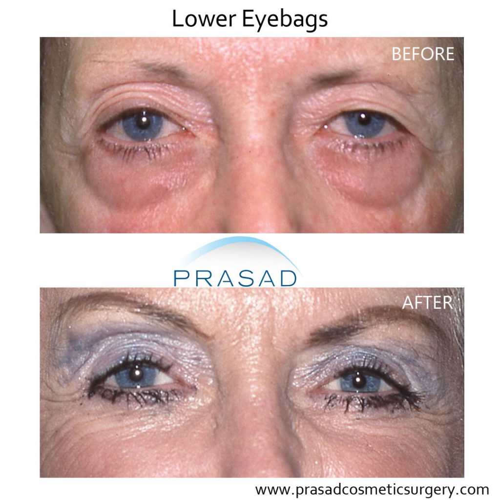 Before and After Eye bags surgery on older female patient
