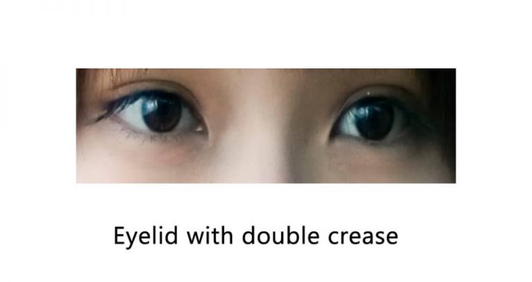 asian female eyelid with double crease
