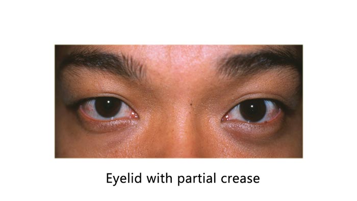 asian male eyelid with partial crease