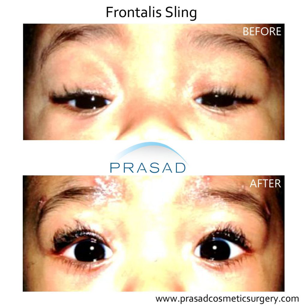 ptosis surgery in children before and after correction surgery