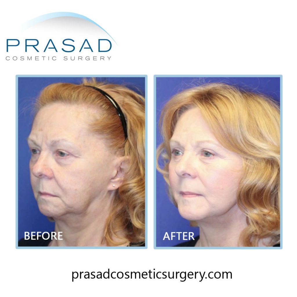 Face and Neck Lift patient Before and After surgery - three-quarter view