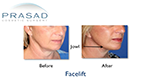 Facelift patient Before and After