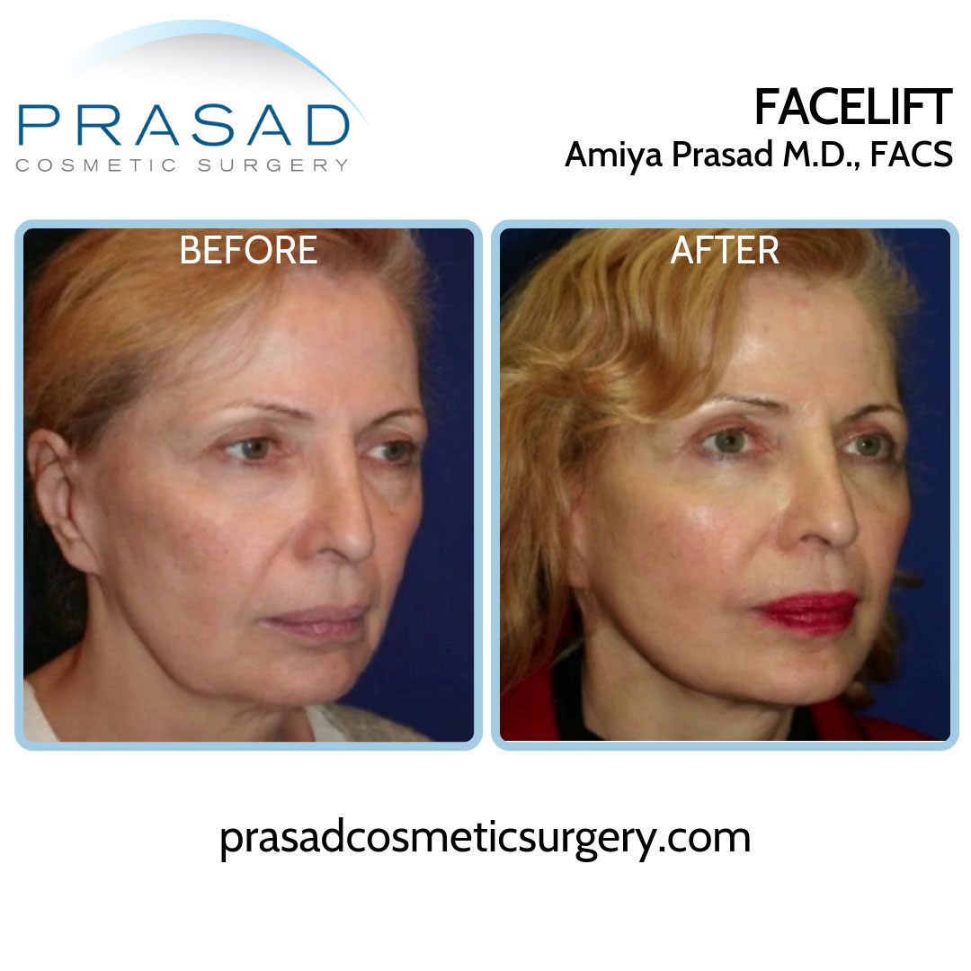 facelift before and after results on female patient