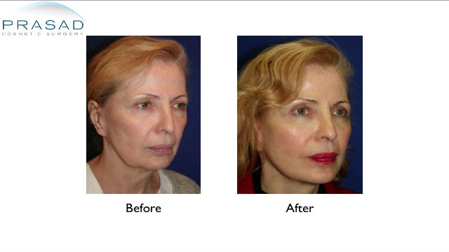 Facelift patient Before and After surgery