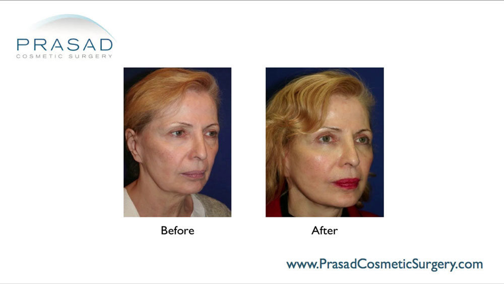 before and after facelift surgery results
