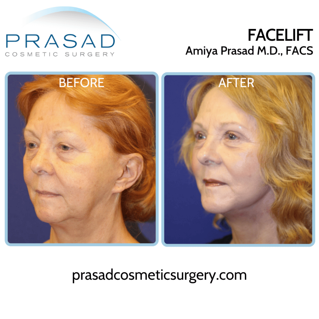 Facelift Scars How They Can Be Minimized Dr Prasad Blog