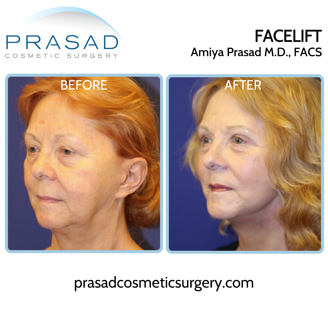 Facelift and neck lift Patient Before and After surgery - three-quarter view