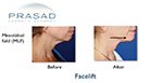 facelift patient before and after photo