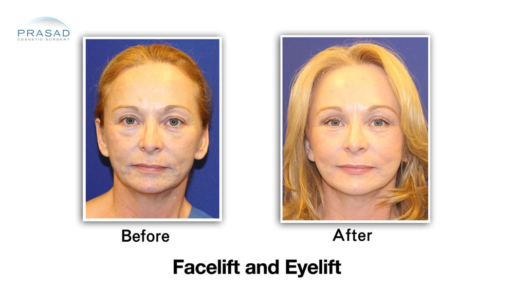 facelift and eyelift before and after results on 50 years old patient