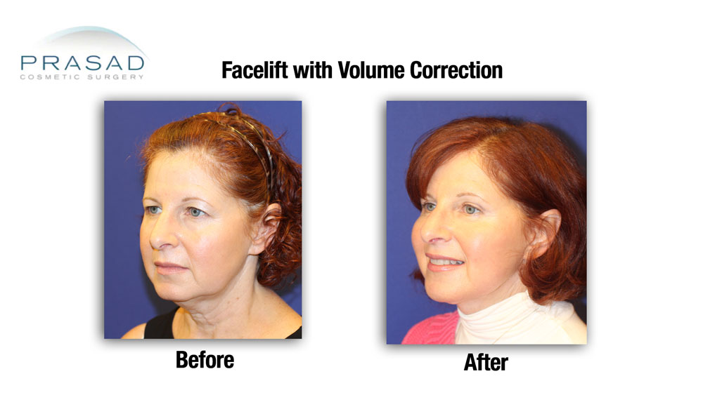 before and after facelift and volume correction