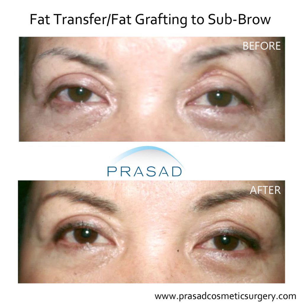 before and after fat transfer to sub-brow to address hollowing