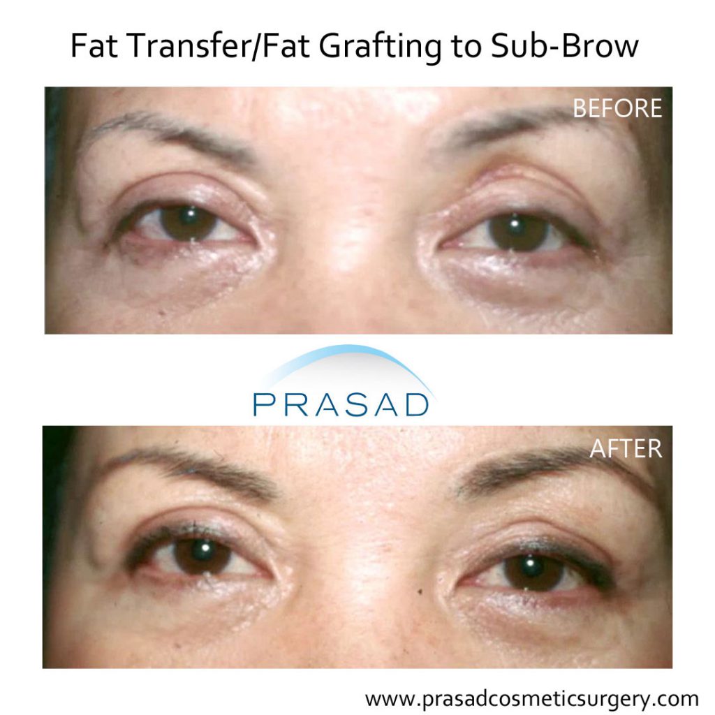 Treating Concurrent Under Eye Puffiness and Hollowness - Prasad Cosmetic  Surgery