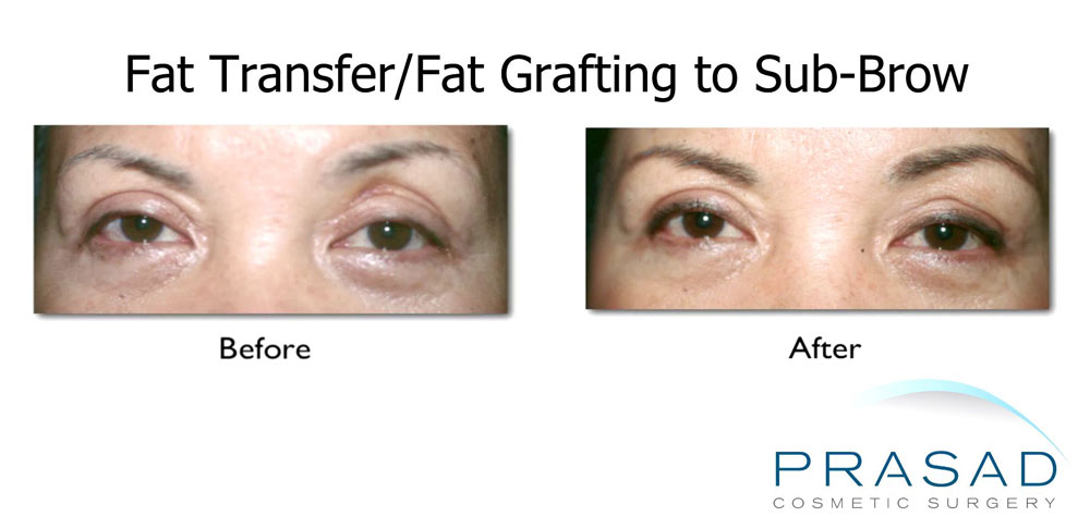 before and after fat transfer to sub-brow to address hollowing