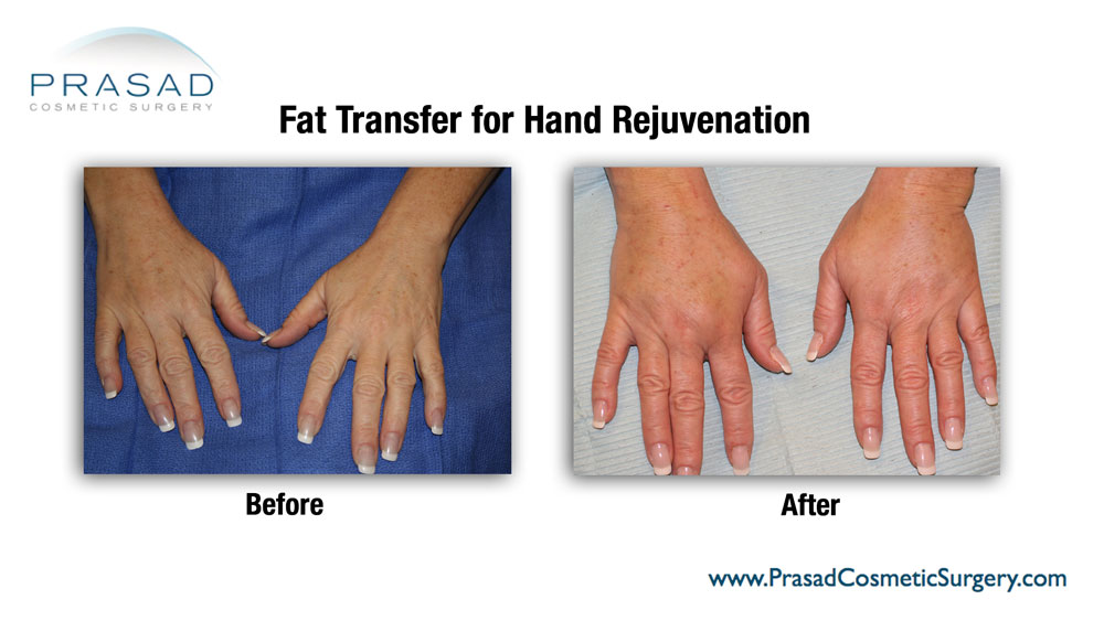 Fat transfer to hands before and after results