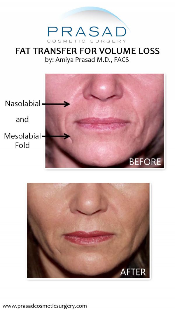 Under Eye Filler for Hollow Eyes, Tear Troughs and Eye Bags