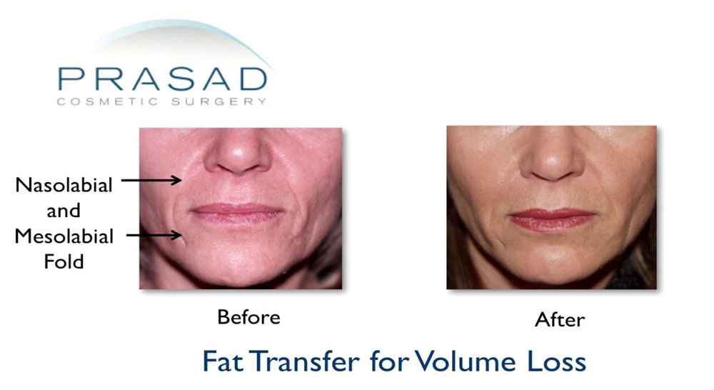 before and after fat grafting face for volume loss