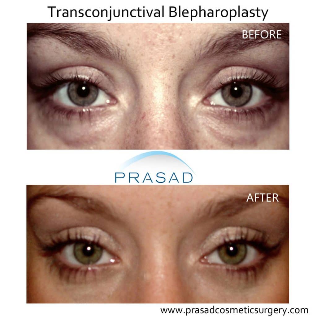 Before and After lower eyelid surgery using Transconjunctival Blepharoplasty technique - female patient