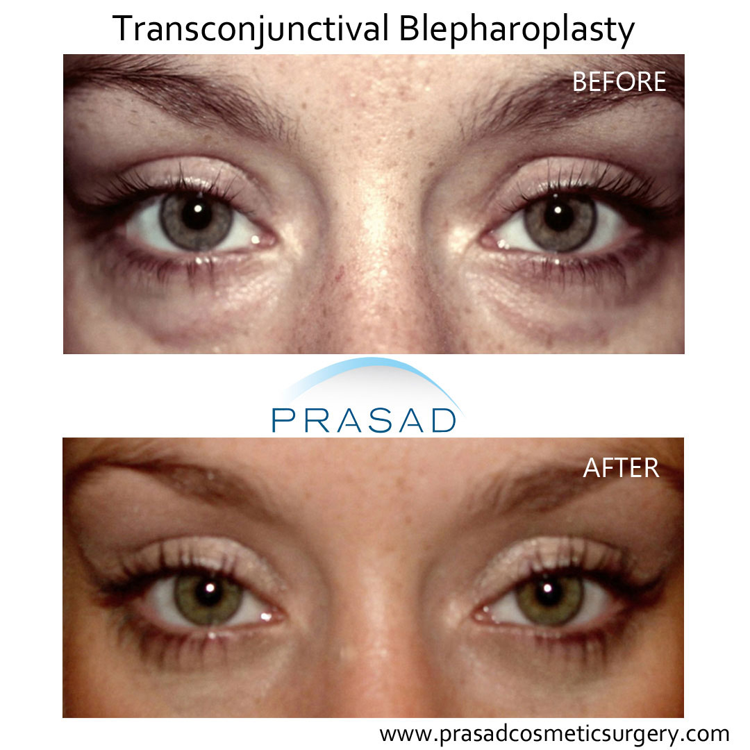 Before and After lower eyelid surgery using Transconjunctival Blepharoplasty technique - female patient