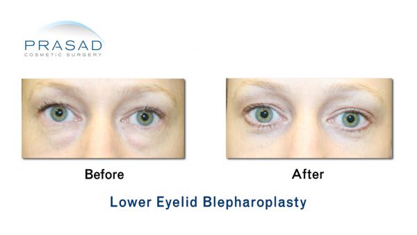 Transconjunctival Blepharoplasty | Eyelid surgery - New York City