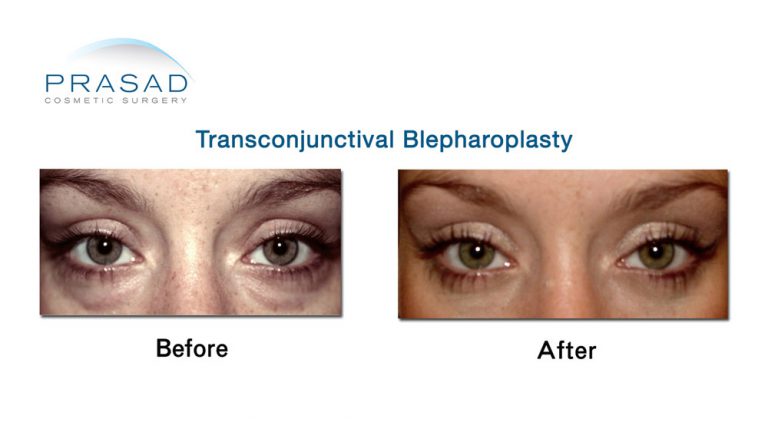 Before and After lower eyelid surgery using Transconjunctival Blepharoplasty technique - female patient