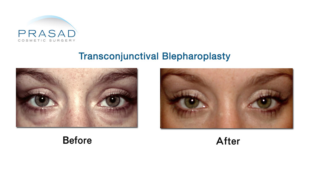 Transconjunctival Blepharoplasty Eyelid surgery New York City