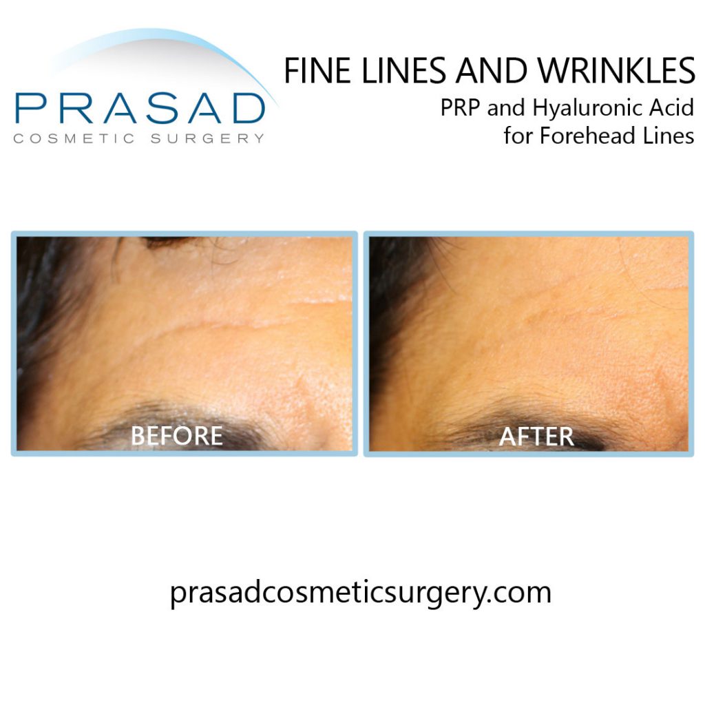 prp for fine lines and wrinkles on the forehead before and after