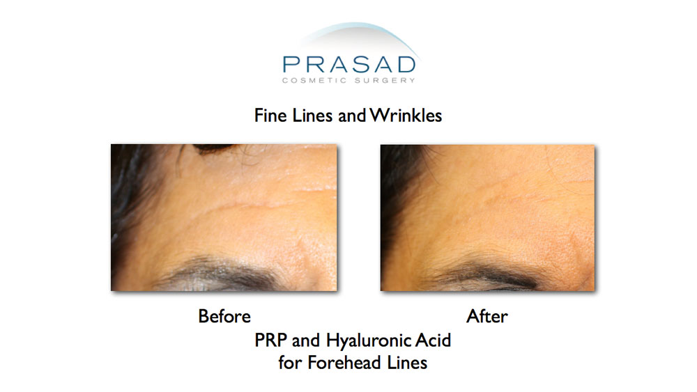 Fine lines and wrinkles on the forehead before and after PRP and cosmetic fillers treatment