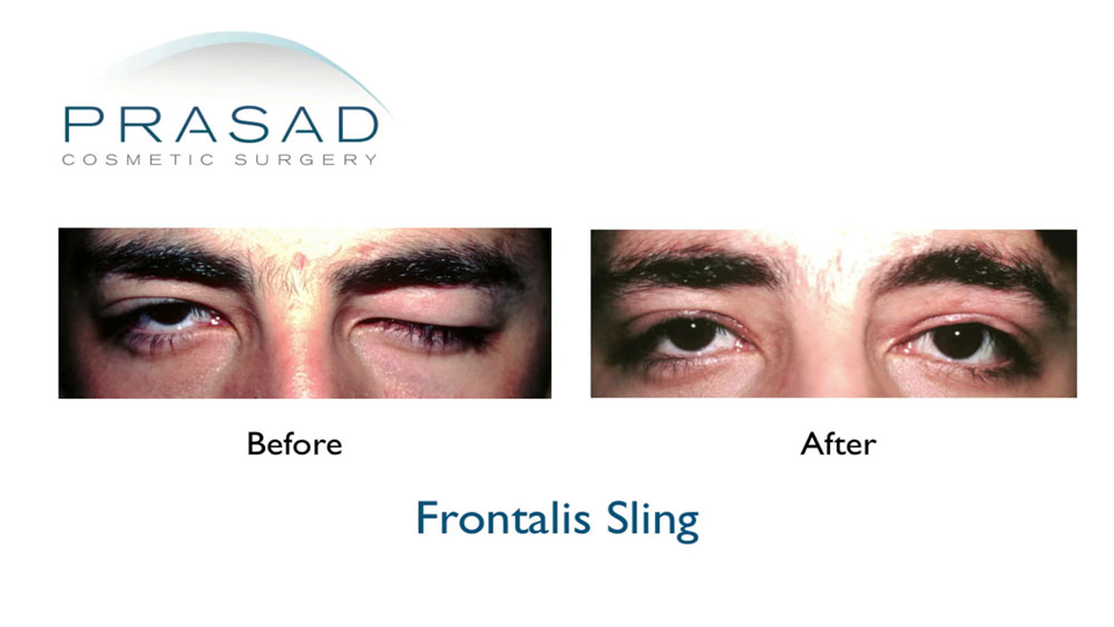 before and after congenital ptosis surgery - male patient