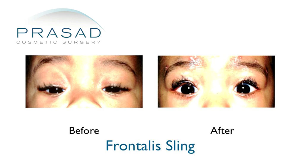 ptosis surgery in children before and after correction surgery