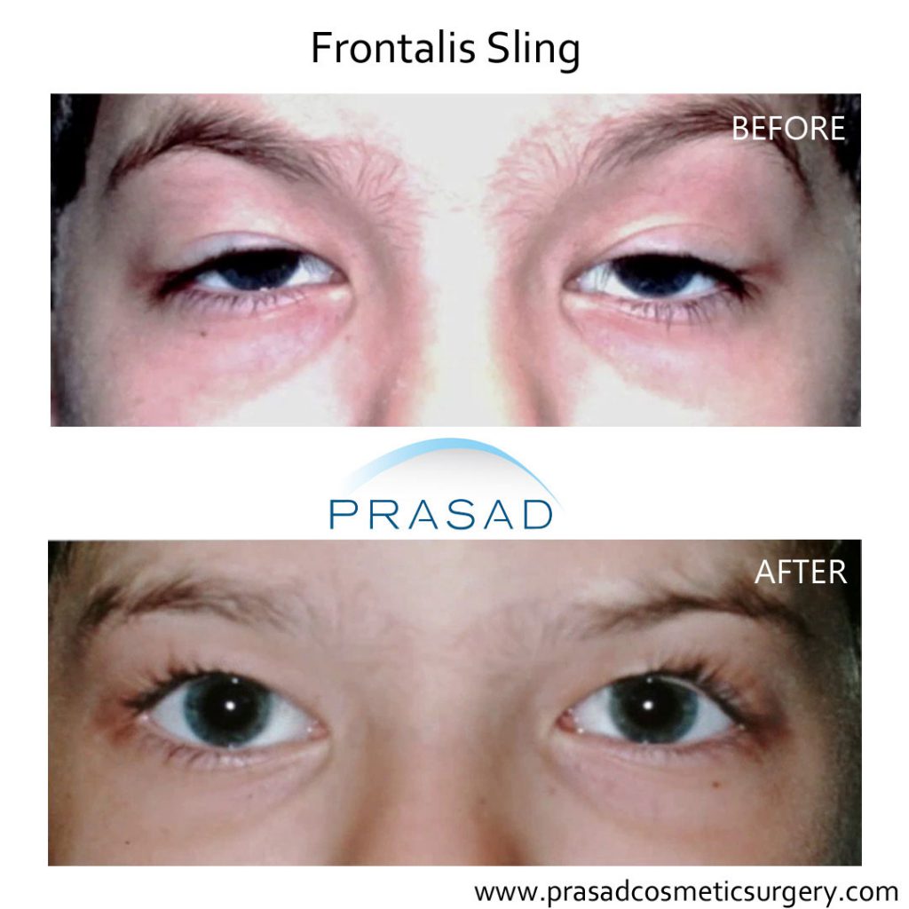 frontalis sling in child before and after surgery by Dr Amiya Prasad