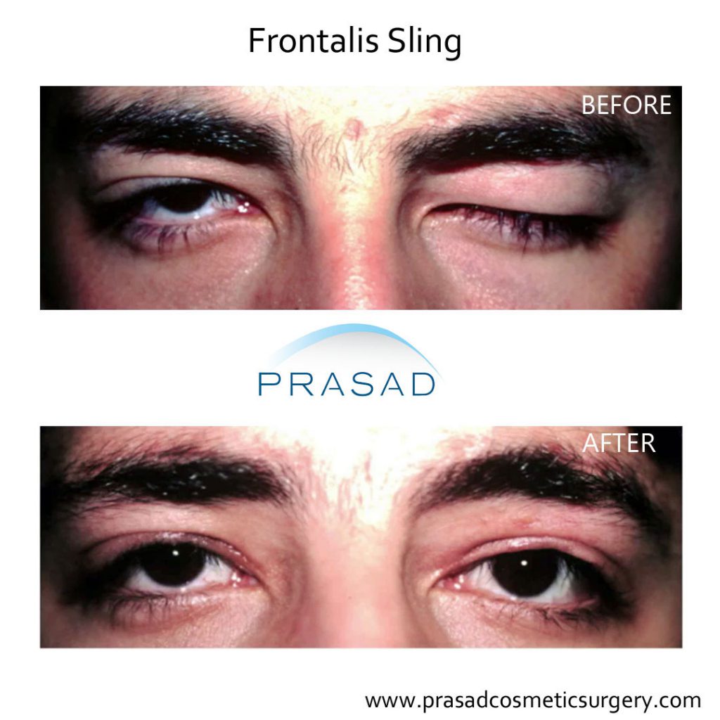 ptosis frontalis sling before and after