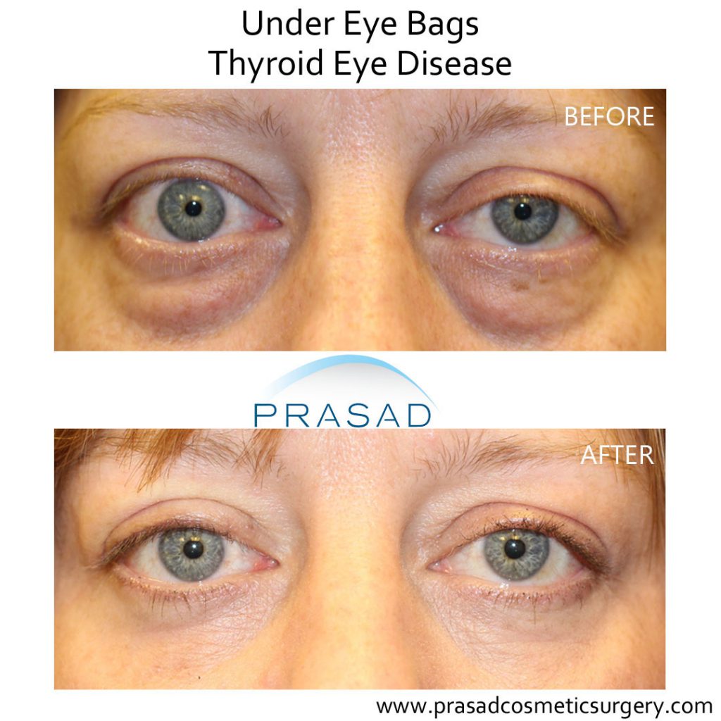 under eye bags and thyroid eye disease before and after