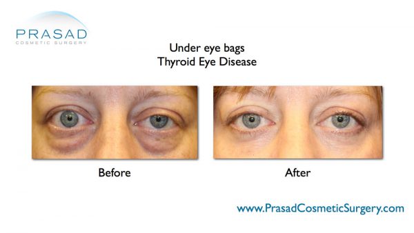 Thyroid Eye Disease Surgery/ Graves Eye Disease Surgery